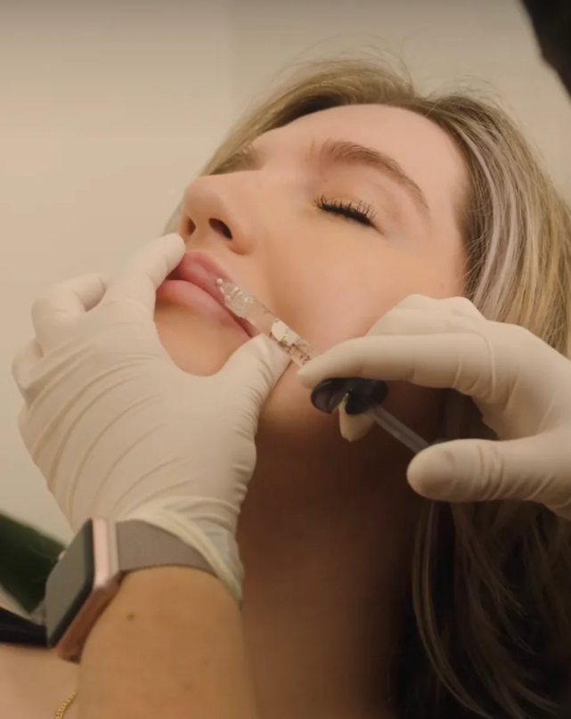 The Ultimate Guide to Lip Filler in Los Angeles: Everything You Need to Know!